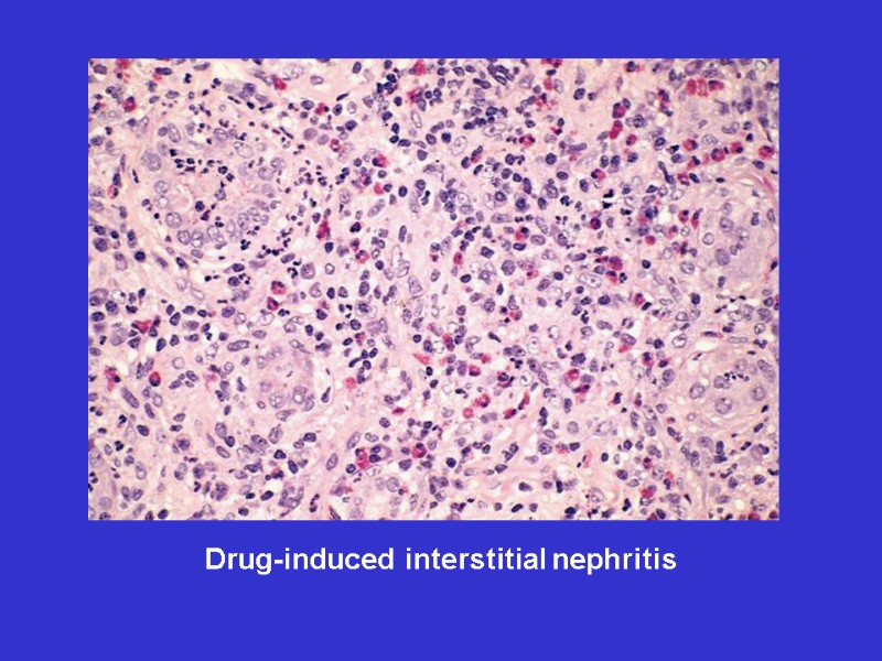 Drug-induced interstitial nephritis